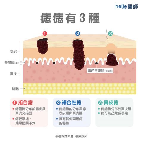 身體 痣|痣是什麼？一次了解痣原因、就醫時機以及如何改善